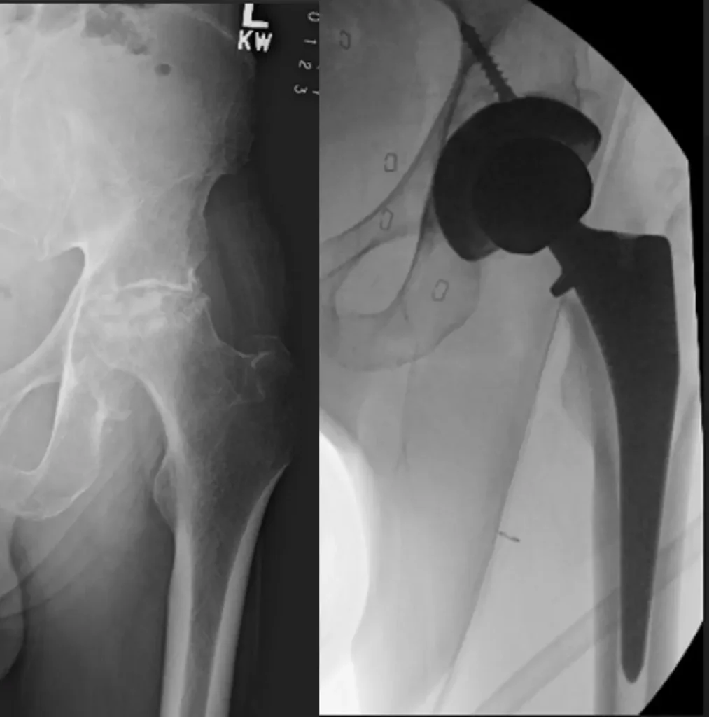Total hip replacement for avascular necrosis of the femoral head