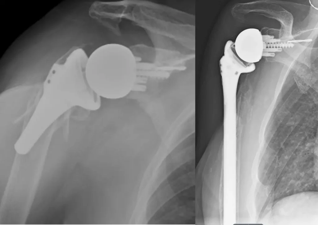 Revision shoulder replacement for periprosthetic fracture