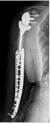 Fixation of a fracture around a previous shoulder replacement
