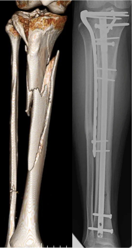 Plate and nail fixation for complex tibial plateau fracture
