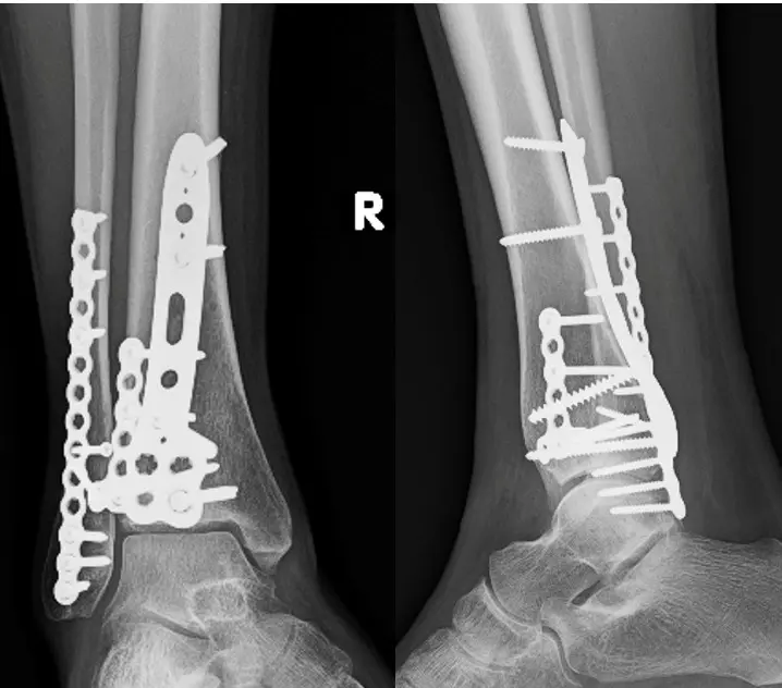 Fixation of pilon fracture
