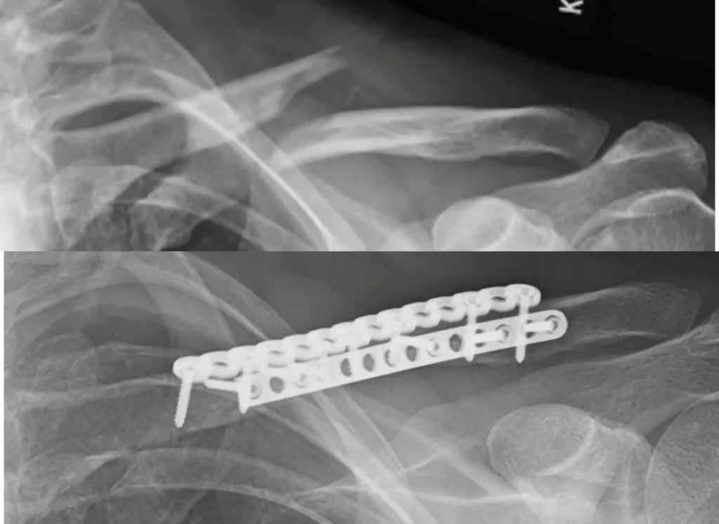 Fixation of displaced clavicle fracture
