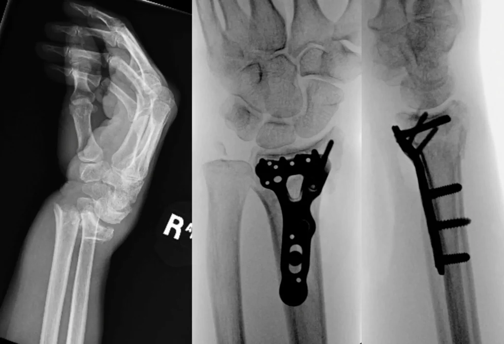 Fixation of displaced distal radius fracture

