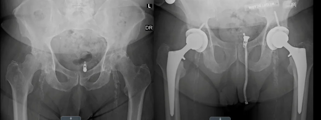 Bilateral anterior total hip arthroplasty for osteoarthritis