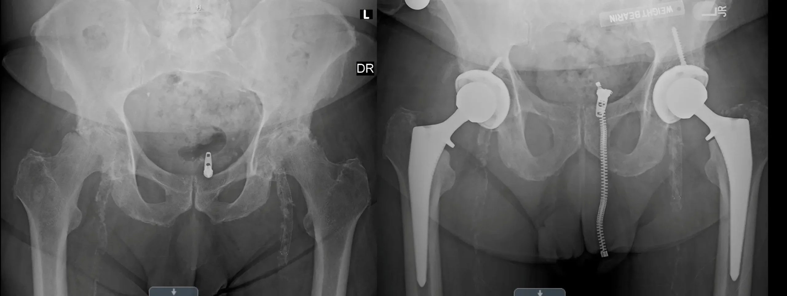2 - Total Hip Replacement