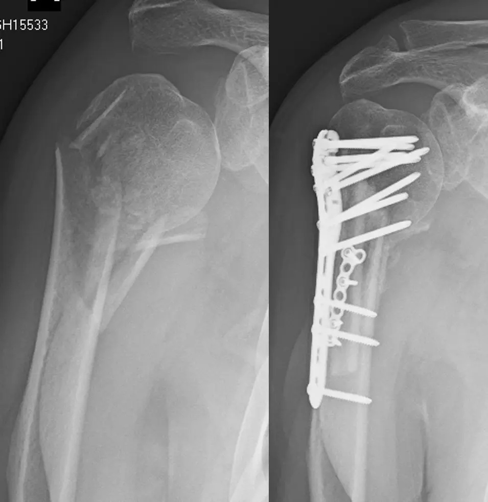 Fixation of comminuted proximal humerus fracture
