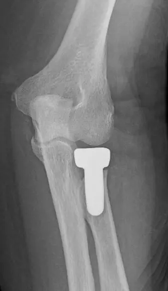Radial head replacement for radial head fracture

