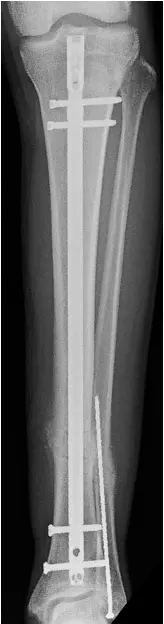 Tibial nail for tibial shaft fracture
