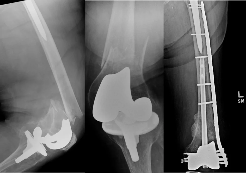 Plate and nail combination for perirprosthetic femur fracture
