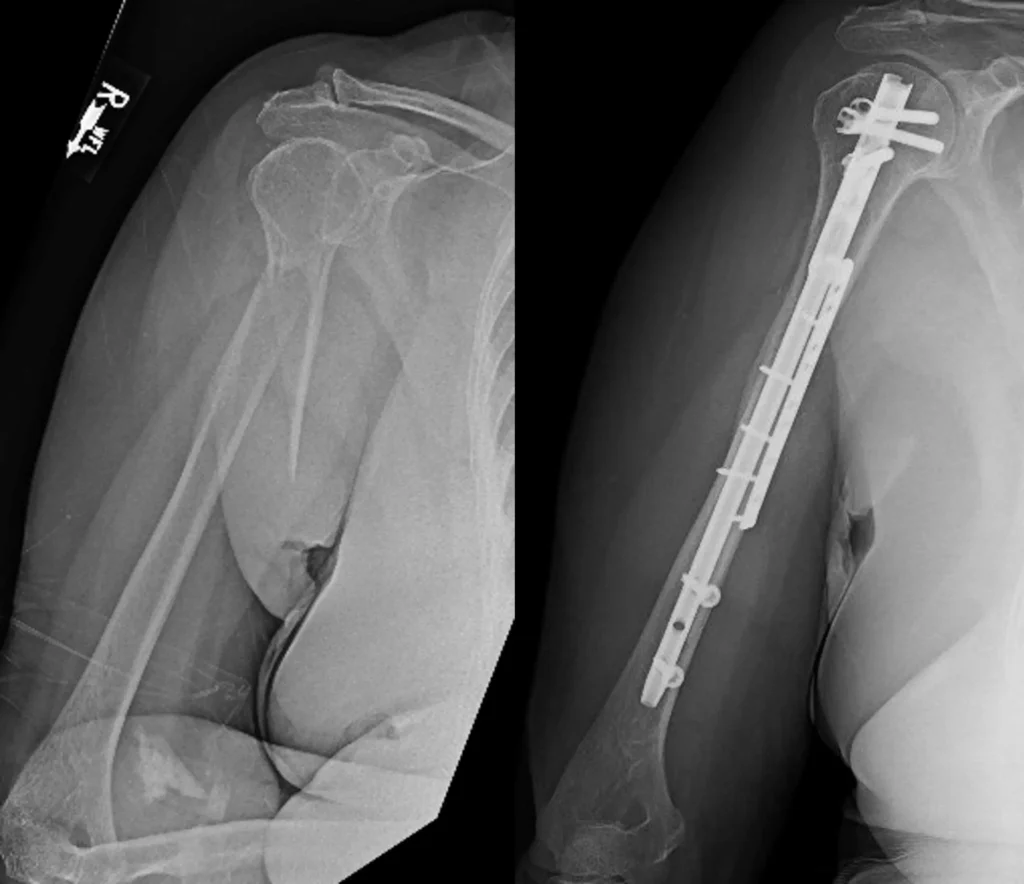 Nail and plate fixation of a humeral shaft fracture
