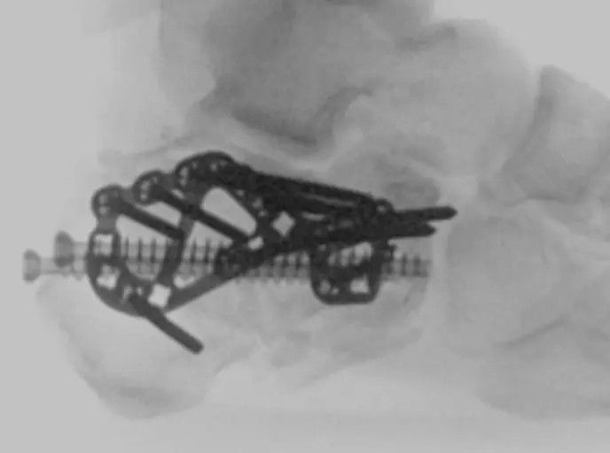 Fixation of calcaues fracture
