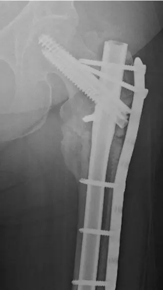 Revision fixation of a femur nonunion
