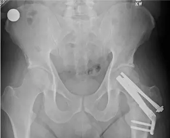 Surgical fixation of a young femoral neck fracture
