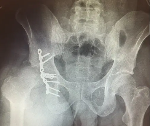 Part A - Conversion total hip arthroplasty for failed acetabulum fixation and hip dislocation