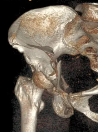 Combined surgical fixation acetabulum and total hip for geriatric acetabulum fracture
