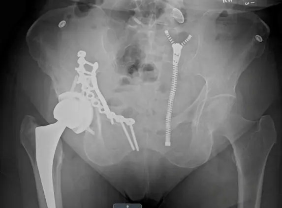 Combined surgical fixation acetabulum and total hip for geriatric acetabulum fracture