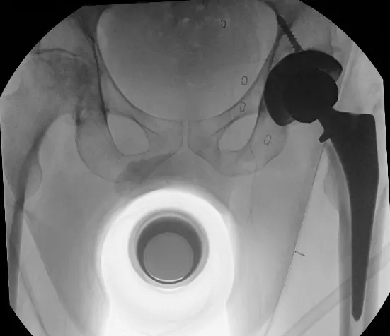 Total hip arthroplasty