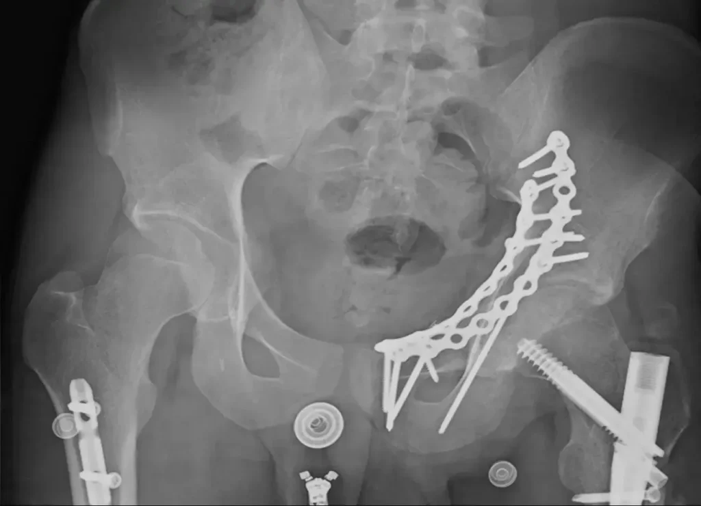 Femur Fracture - After