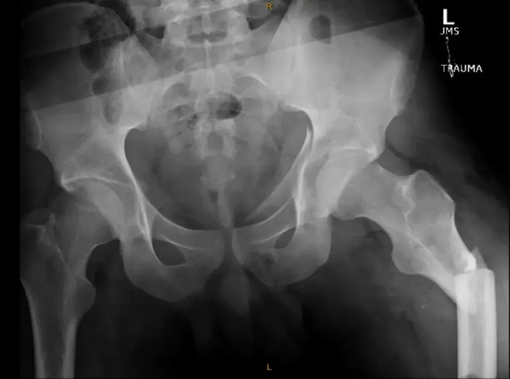 Femur Fracture - Before