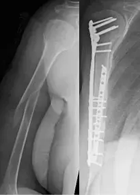 Fixation of humeral shat fracture
