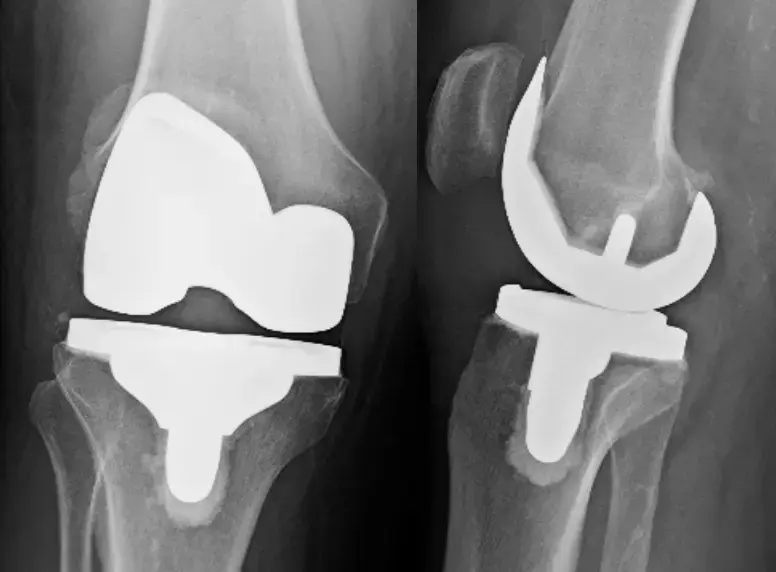 Total Knee Arthroplasty (TKA)
