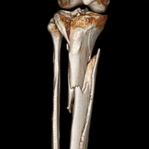Total Knee Arthroplasty